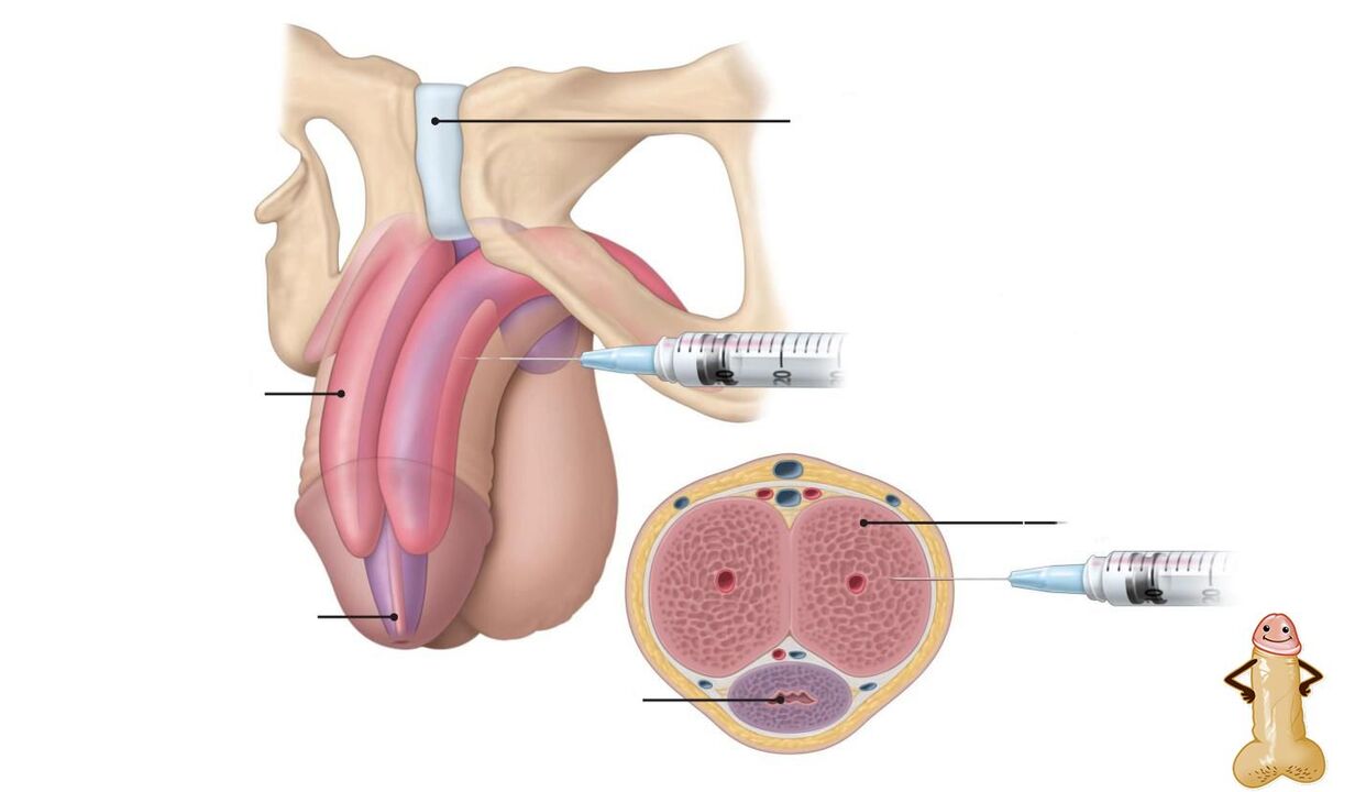 injections of hyaluronic acid for penis enlargement